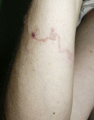Lesión sobreelevada serpiginosa en antebrazo.