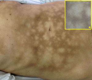 Manchas hiperpigmentadas de distribución reticular en la región abdominal, desde las crestas iliacas hasta la región submamaria bilateral. Detalle de la imagen (*).