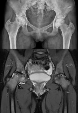 Radiografía AP de pelvis y corte coronal secuencia T2 RMN de pelvis.