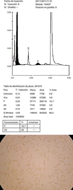 Electroforesis de hemoglobina y test de falciformación.