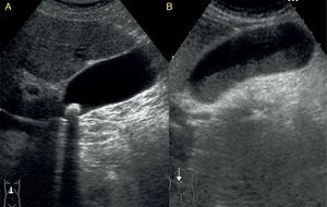 Corte longitudinal en el hipocondrio derecho. A: colelitiasis, imagen intravesicular hiperecogénica con sombra posterior a nivel del cuello. B: barro biliar, ocupación de la porción más declive de la vesícula con material ecogénico y con nivel horizontal.