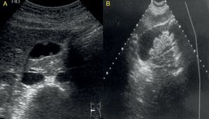 Corte transversal en el hipocondrio derecho. A: pólipos, lesiones ecogénicas, redondeadas, adheridas a la pared y sin sombra posterior. B: tumor vesicular, gran masa intravesicular con bordes irregulares.