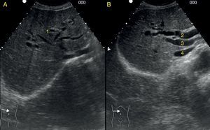 Corte oblicuo a nivel del epigastrio. A: dilatación de las vías biliares intrahepáticas con la imagen en estrella o en brazos de pulpo (1). B: dilatación del colédoco con la imagen «en cañón de escopeta» (2), vena porta (3) y vena cava inferior (4).