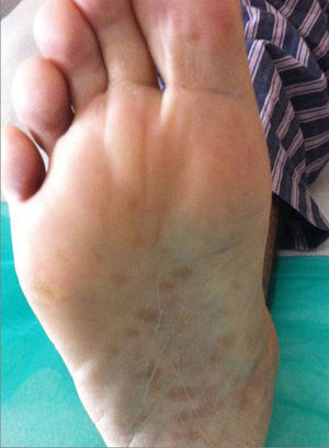 Detalle de las lesiones cutáneas en las plantas de los pies.