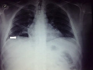 Radiografía AP de tórax. Imagen quística, redondeada en base derecha sin niveles en el interior (flecha blanca).