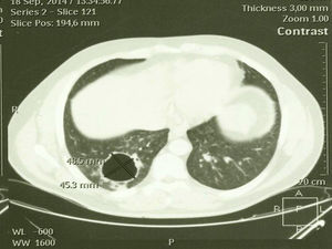 TAC torácico, corte axial. Imagen quística, redondeada en base pulmonar derecha de 48×45mm.