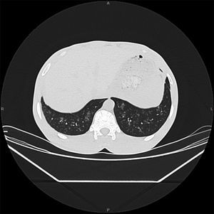 TAC de tórax con pequeños infiltrados acinares de predominio periférico en bases pulmonares.
