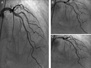 A: Coronariografía izquierda, lesión severa en tercio medio de la arteria descendente anterior. B: Angioplastia de la lesión en descendente anterior. C: Resultado final de la angioplastia de la arteria descendente anterior e implante de stent.