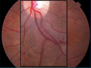 Oftalmoscopia indirecta del paciente, retinopatía hipertensiva grado ii de la clasificación de Keith-Wagener-Barker (intensa constricción vascular y signos de Gunn en los cruces arteriovenosos, ocultamiento de la columna sanguínea de la vena por compresión de la arteriola esclerótica en un cruce arteriovenoso, vénulas dilatadas y arterias en «hilo de plata») y también retinopatía aterosclerótica grado ii de la clasificación de Scheie.