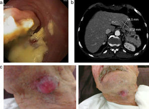 a. Imagen endoscópica de la tumoración esofágica. b. Tomografía computarizada donde se observa la metástasis hepática. c. Metástasis por contigüidad del carcinoma adenoescamoso esofágico.