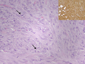 Biopsia: proliferación de células fusocelulares con atipia moderada y presencia de mitosis (flechas). Recuadro: la tinción con vimentina evidencia la naturaleza mesenquimal de la tumoración.