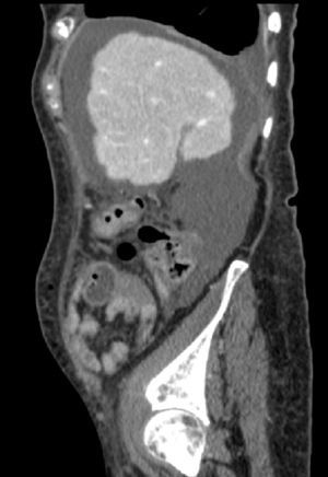 TC abdominal donde se aprecian irregularidades en la superficie hepática y hemoperitoneo importante en el 7.° día del postoperatorio de la paciente del caso 2.