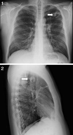 Radiografía simple de tórax que muestra imagen cavitada en el lóbulo superior izquierdo (flecha blanca.