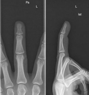 Radiografía simple, sin evidencia de fractura o arrancamiento.