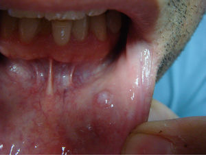 Mucocele subepidérmico.