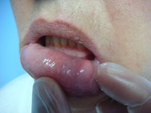 Mucocele intradérmico.