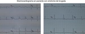 Izquierda: elevación descendente del segmento ST con ondas T negativas en precordiales derechas (V1-V3). Derecha: rectificación del segmento ST en precordiales derechas, 12horas más tarde.