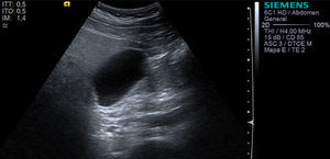 Ecografía abdominal del paciente, con ausencia de imágenes litiásicas en la vesícula biliar