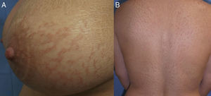 Clínica. A. Fisuras eritematodescamativas en ambas mamas. B. Escamas marronáceas adheridas en la espalda sin inflamación asociada.