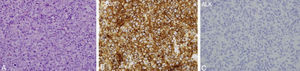 Histología del ganglio linfático. A. Presencia de un infiltrado linfocitario de características atípicas que borra la estructura normal del ganglio (H-E x100). B. El infiltrado era predominantemente CD30+ (x100). C. El marcador ALK era negativo (x100).