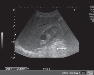 Riñón derecho con una lesión de 21,5mm en la cortical renal a nivel del polo superior, anecoica circular no septada con refuerzo posterior.
