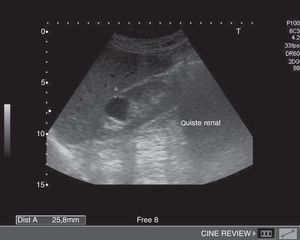 Evolución del quiste renal derecho de la figura 2 un año después.