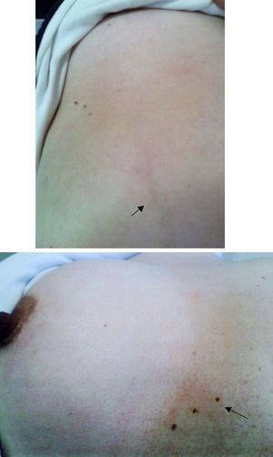 Eritema y cordón de 7cm de longitud, arrosariado palpable (flecha), submamario derecho.