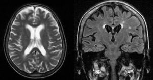 Izquierda: corte axial donde se aprecia atrofia córtico-subcortical difusa. Derecha: corte coronal donde se observan hiperintensidades multifocales. Estos hallazgos en la resonancia magnética evidencian encefalopatía alcohólica.
