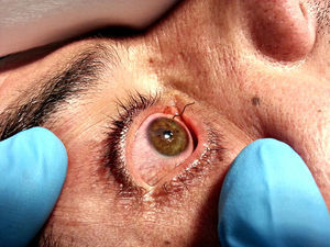 Cuerpo extraño metálico que atraviesa córnea, iris y cristalino.