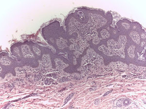 Tinción con hematoxilina-eosina en la que se evidencia una hiperplasia epidérmica irregular con infiltrado celular mononuclear en la dermis papilar, y perivascular en la dermis superficial.