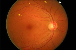 Retinopatía diabética leve. Las flechas señalan microaneurismas.