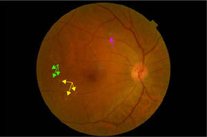 Retinopatía diabética moderada. Las flechas cuyas puntas van hacia abajo señalan exudados duros y hemorragias, mientras que la flecha cuya punta va hacia arriba señala un exudado blanco algodonoso.