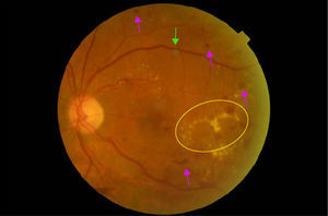 Retinopatía diabética severa. El círculo señala exudados duros en circinada. Las flechas cuyas puntas van hacia arriba señalan hemorragias intrarretinianas severas, y la flecha cuya punta va hacia abajo señala un exudado blanco algodonoso.