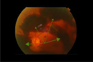 Retinopatía diabética proliferativa. Las flechas señalan el hemovítreo.