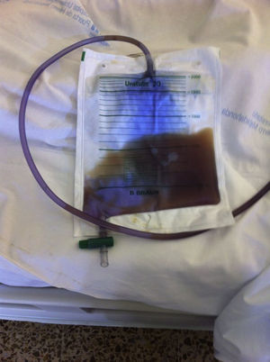 Bolsa de sondaje de la paciente con coloración púrpura.