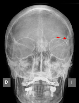 Radiografía craneal. Asimetría ósea a nivel parietal izquierdo.