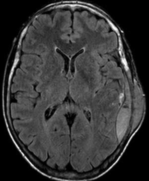Resonancia magnética nuclear. Lesión expansiva en la región parietal izquierda de la calota craneal, con componente extracraneal e intracraneal extraaxial.