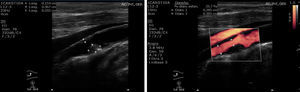 Trombo reciente en arteria carótida interna derecha, segmento proximal, pared anterior de 5×3 mm en 2D y en Doppler.