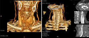 Reconstrucción en angiotomografía de arteria carótida interna derecha, sin visualización del trombo.
