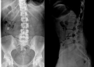 Radiografía lumbosacra que muestra una imagen compatible con osteítis condensante ilíaca izquierda.