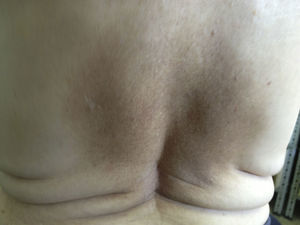 Placa hiperpigmentada de bordes imprecisos e irregulares en la espalda.