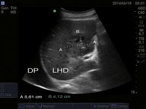 imagen ecográfica en la que observamos el hígado, concretamente el lóbulo hepático derecho (LHD), y en su espesor podemos apreciar una lesión heterogénea de unos 5,61×4,13cm, compatible con el absceso hepático. Por otro lado, también resulta evidente el derrame pleural derecho (DP) que presenta el paciente.