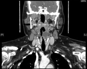 Muestra un corte coronal de un TAC. En la imagen se observa una lesión quística en el ventrículo laríngeo compatible con un laringocele.