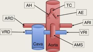 Esquema de los grandes vasos abdominales. TC: tronco celíaco, la primera rama de la aorta abdominal, que al poco de su nacimiento se bifurca en la arteria hepática (AH) que discurre hacia la derecha del paciente, y la arteria esplénica (AE), que se dirige a la izquierda, en dirección al bazo. La segunda rama de la aorta abdominal es la arteria mesentérica superior (AMS), que al poco de nacer se dirige caudalmente paralela a la aorta, formando un espacio entra ellas, la llamada pinza aorto-mesentérica, por donde discurre transversalmente la vena renal izquierda (VRI) en su recorrido hacia la cava inferior. Las arterias renales nacen de la cara lateral de la aorta; la arteria renal derecha (ARD) se dirige hacia el riñón derecho pasando por detrás de la cava, mientras que la arteria renal izquierda (ARI) se dirige al riñón izquierdo directamente. La VRI aboca la cara lateral de la vena cava inferior, previamente ha pasado por la pinza aorto-mesentérica en su camino procedente del riñón izquierdo; y la vena renal derecha (VRD) viene del riñón correspondiente abocando en la cara lateral derecha de la cava directamente.