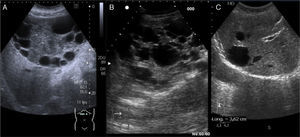 A)Corte transverso de epigastrio. Quiste hidatídico multivesicular. B)Corte transverso de hipocondrio derecho. Poliquistosis hepática. C)Corte longitudinal de hipocondrio derecho. Quiste simple hepático.