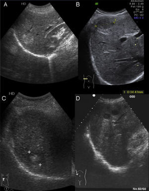 A)Corte longitudinal de hipocondrio derecho. Angioma hepático típico. B)Corte transversal de hipocondrio derecho. Angioma hepático atípico. C)Corte longitudinal de hipocondrio derecho. Hepatocarcinoma. D)Corte oblicuo de hipocondrio derecho. Mestástasis hepáticas.