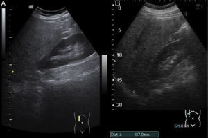 A)Corte longitudinal de hipocondrio derecho. Esteatosis (ecogenicidad hepática mayor que la corteza renal). B)Corte longitudinal de hipocondrio derecho. Hepatomegalia (eje longitudinal de unos 18cm).