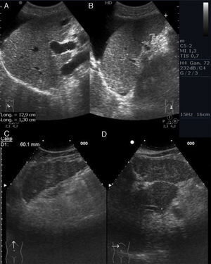 Signos de hepatopatía crónica. A)Corte oblicuo de hipocondrio derecho. Dilatación de la porta y ascitis. B)Corte longitudinal de hipocondrio izquierdo. Esplenomegalia y ascitis. C)Corte longitudinal de epigastrio. Bordes irregulares del lóbulo hepático izquierdo. D)Corte transversal de hipocondrio derecho. Hipertrofia del lóbulo caudado.