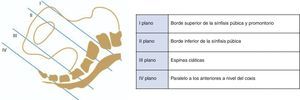 Planos de Hodge. Los planos de Hodge representan el descenso de la presentación fetal en la pelvis materna. La altura de cada uno de estos planos está definida por una referencia anatómica.