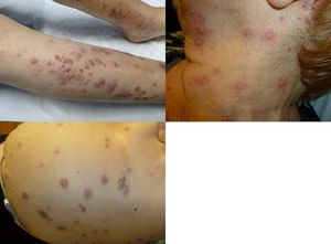 Caso 1: La paciente presentaba lesiones vesiculoampollosas sobre base eritematosa localizadas en piernas, cabeza y cuello, y abdomen, respectivamente. Las lesiones comenzaron en pierna izquierda, con generalización posterior.